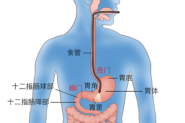 賁門癌是什么意思，賁門癌該怎么治療